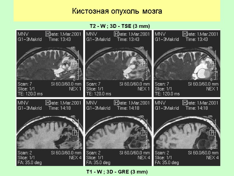 Кистозная опухоль мозга    T2 - W ; 3D - TSE (3